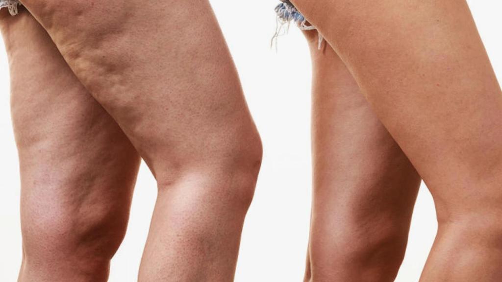 Lipödem Hakkında Bilmeniz Gerekenler Lipödem Hakkında Bilmeniz Gerekenler