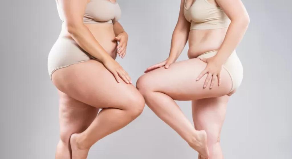 Lipödem Nedir ? Lipödem Nedir ?